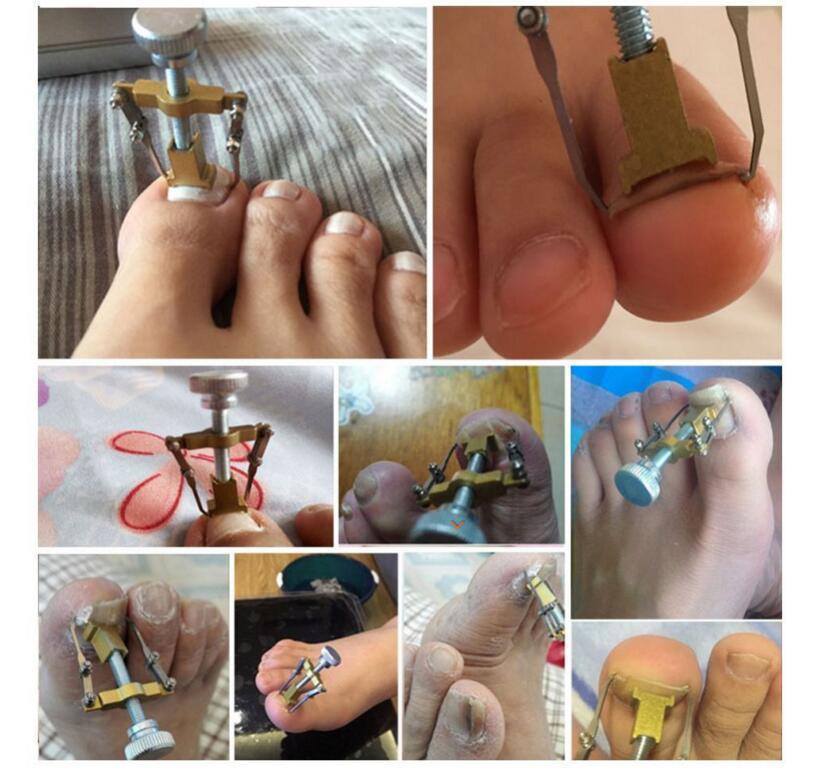 Ingrown Toe nail Correction Onychocryptosis appliance Coil corrector