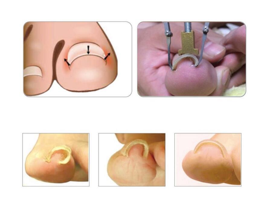 Ingrown Toe nail Correction Onychocryptosis appliance Coil corrector