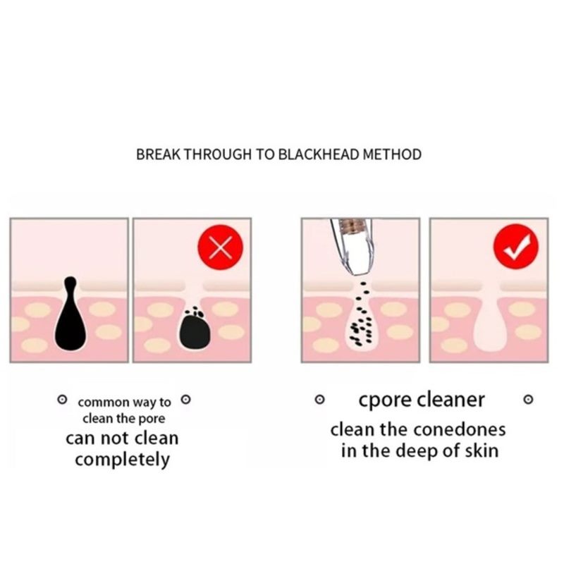 Blackhead Remover Black Head Remover